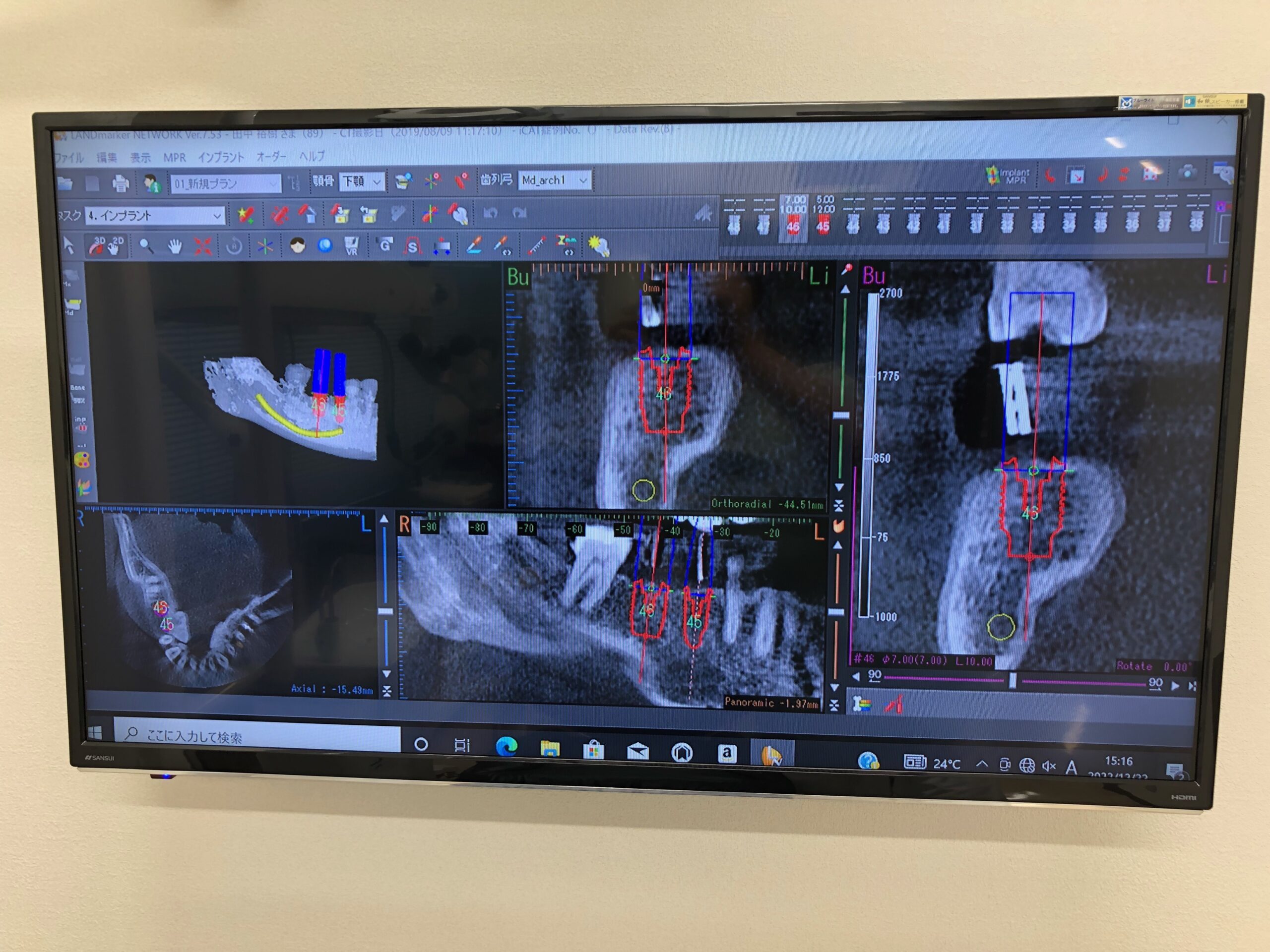 インプラントのレントゲン